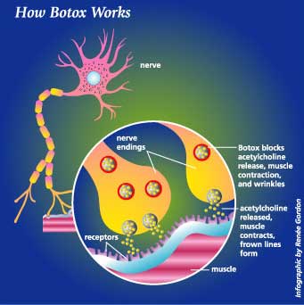 How Botox® / Vistabel® works